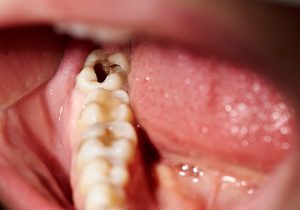 close up of teeth and a cavity