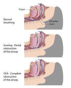 diagram of obstructive sleep apnea