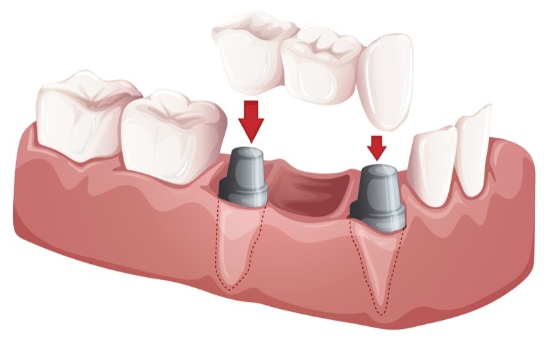 What is a Dental Bridge?