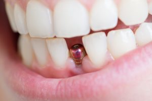 restoring front teeth- dental implant