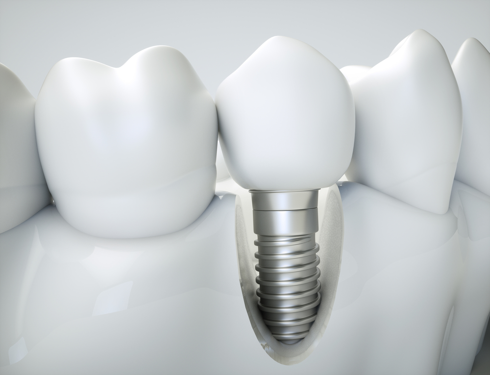 How Implants Can Work For You: The Versatility of Dental Implants