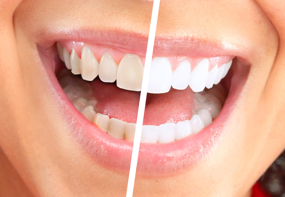 Is ZOOM! Teeth Whitening Right for You?