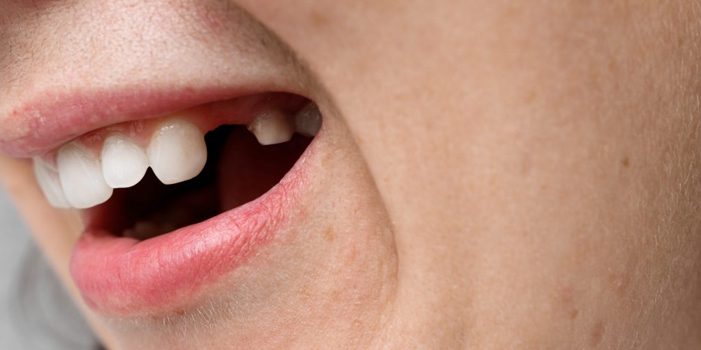 close up of mouth with a missing tooth