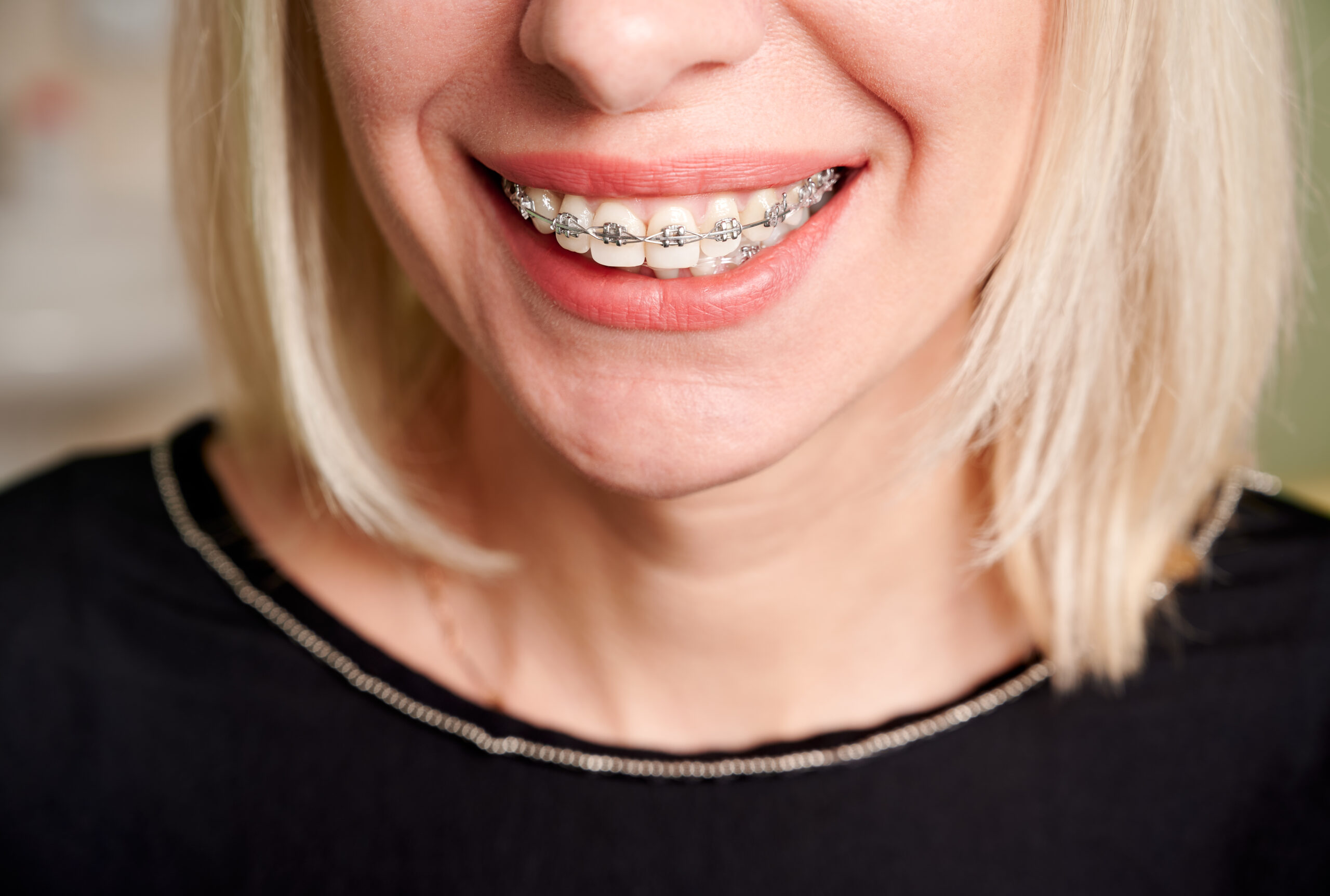 Everything You Need To Know About Adult Braces