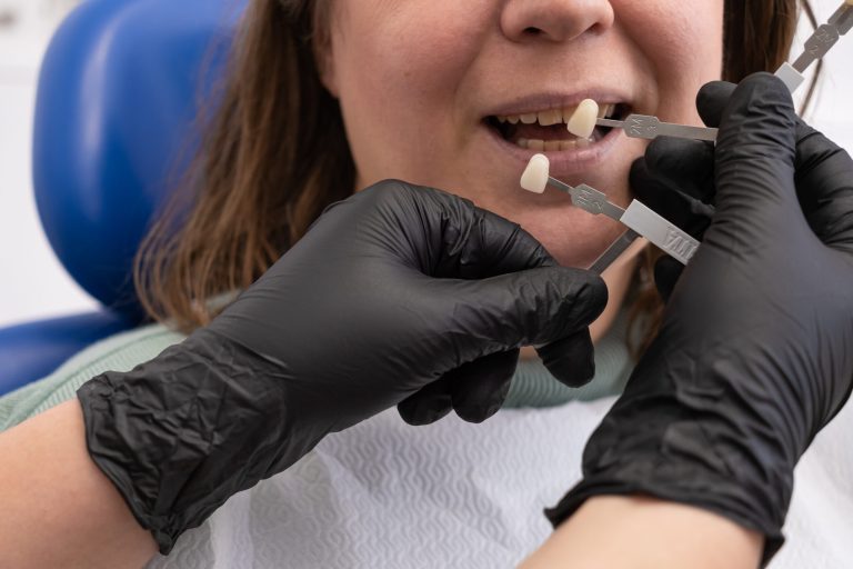 dentist holding up veneers to match tooth color